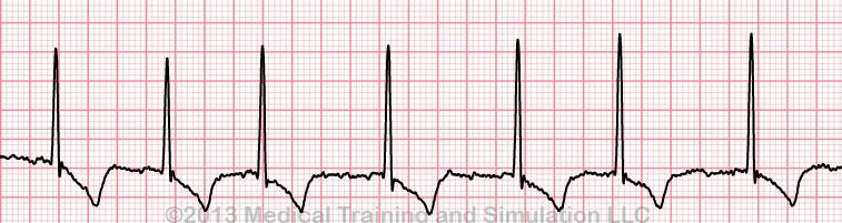 Irregular Very fast (> 350 bpm) for Atrial, but ventricular rate may be slow, normal or fast