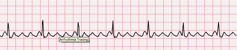 Regular or irregular Fast (250-350 bpm) for Atrial, but ventricular rate is often slower