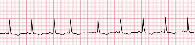 Irregular Usually normal but depends on underlying rhythm Notes
