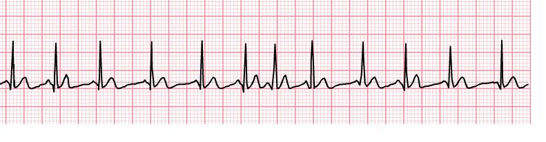 Notes Irregular Fast (> 100 bpm) Often changing shape and size from beat to beat (at least three differing