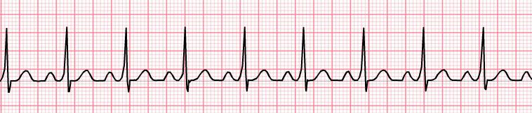 Notes Regular unless atrial fibrillation present Normal (60-100 bpm) Normal Can be short (<0.12 sec) Usually wide (> 0.