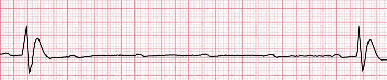 Notes Regular, but atrial and ventricular rhythms are independent Characterized by Atrial rate usually normal and faster than ventricular rate