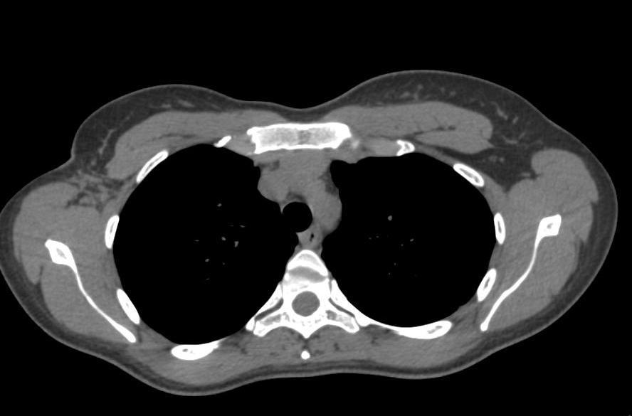 Pektoralis major kası Pektoralis minör kası Latissimus dorsi