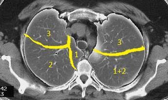 Üst lob anterior 4. Orta lob lateral 4.