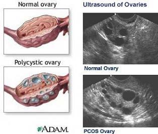 PCOS Üreme çağında hirsutizmin en sık nedeni LH ve/veya insülin uyarısı sonucu theca hücrelerinden androjen üretiminde artış Adrenal androjen artışı sonucu T ve DHEAS yükselir