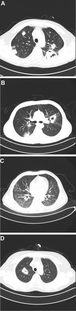 Pulmoner