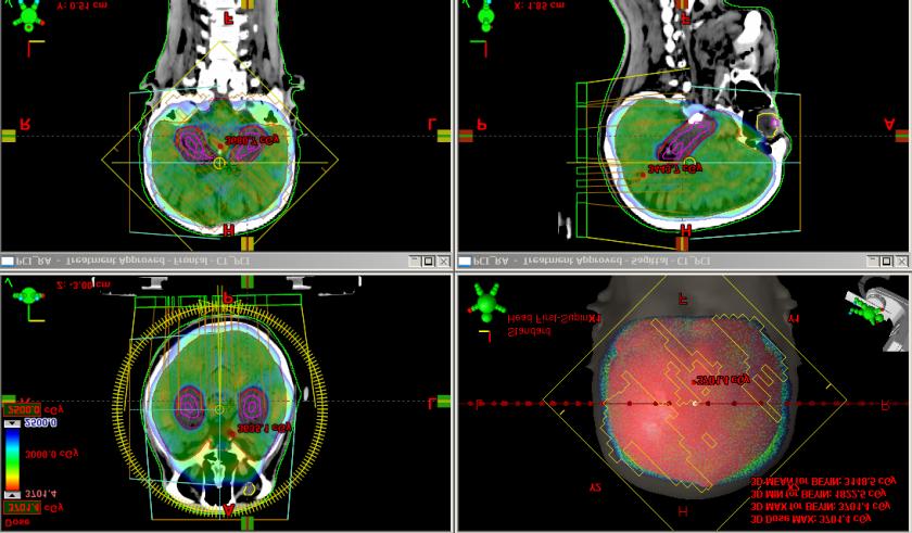 Hipokampus/nöral kök hücre korumalı Tüm beyinrt RTOG 0933 sonucunda: Tüm beyin radyoterapisi