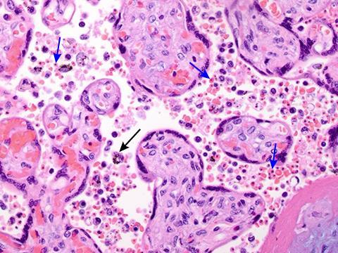 Patogenez P falciparum enfekte eritrositler immunolojik olarak gebe olmayan kadınlardaki enfekte eritrositlerden farklı -Spesifik sınıf bir varyant yüzey antijeni sentezlerler (gebelik ilişkili