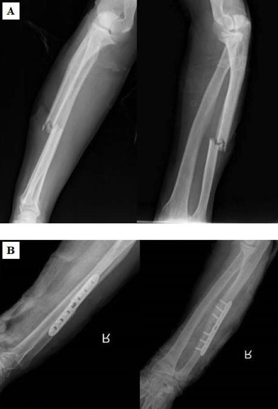 TOLUNAY ve ark. İzole ulna cisim kırıklarında tedavi yöntemleri Şekil 1. Ameliyat öncesi (A) ve ameliyat sonrası (B) grafiler Şekil.