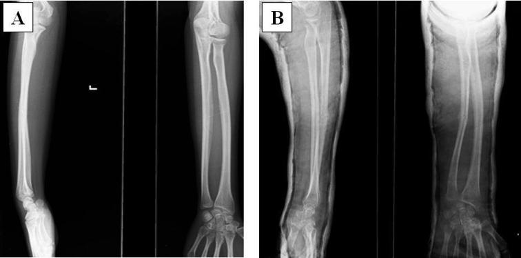 İzole ulna cisim kırıkları konservatif tedavi düşünülebilecek belki de tek ön kol kırığıdır.