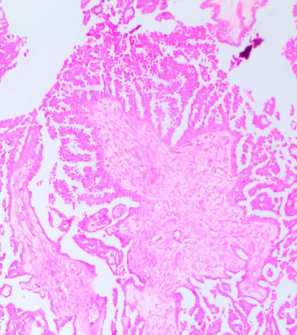 Mikropapiller/Kribriform Morfoloji