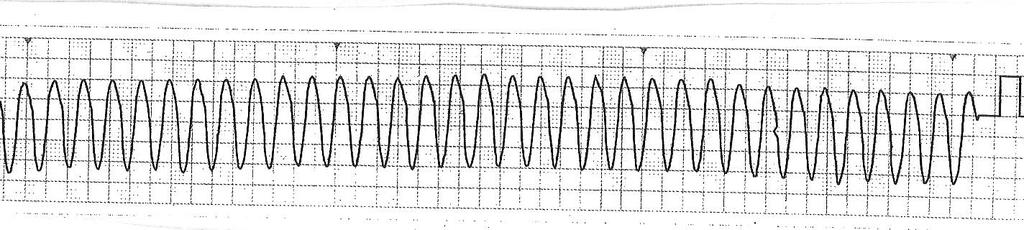 Monomorfik VT Hız: Sıklıkla 120 den fazla Ritm: Çoğunlukla düzenli P dalgası: Hızlı VT de çoğunlukla görülmez.