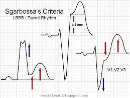 Sol dal bloğu ve MI QRS ile aynı yönde (concordans) 1 mm ST elevasyonu 5 puan V1, V2, V3 derivasyonlarında 1mm ST depresyonu 3 puan QRS ile zıt yönde (discordans) olan 5 mm ST elevasyonu 2 puan