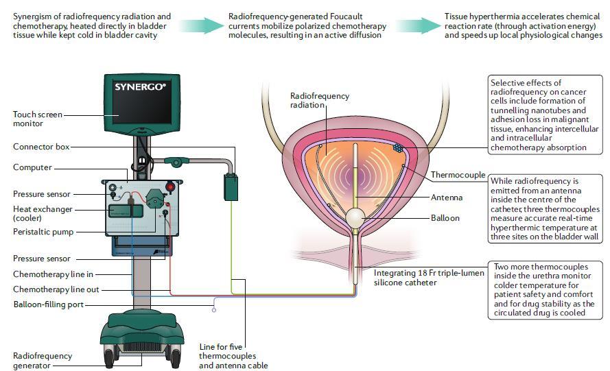 RITE (Synergo) thermocoupled kateter ve mikrodalga cihazı Mesane duvarı RF ile hipertermisinin intravesikal MMC ile kombinasyonu