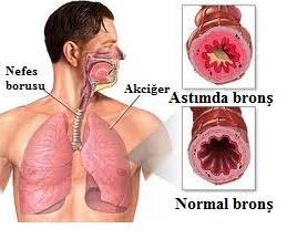 Hava yolu darlığı Bronş etrafındaki düz kas