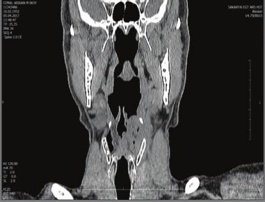 olduğu görüldü. Şekil 2: Boyun bilgisayarlı tomografi incelemesinde sol sinüs priformiste asimetrik daralmaya neden olan kitlesel lezyon görüldü.