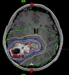 8-13 3-DCRT/IMRT 20-46 Gy