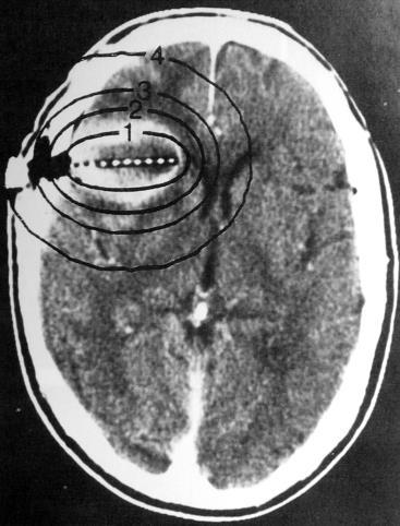 RT Trials Brachytherapy boost