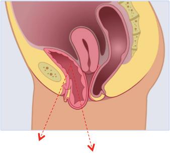 Mesane yer çekiminin etkisi ile vajene doğru basar mesane çıkışında üretra sıkışır.