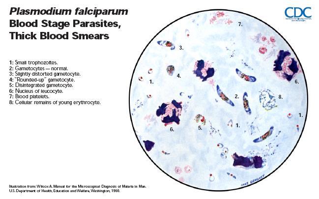 Plasmodium falciparum Periferik kanda olgun trofozoit, geç