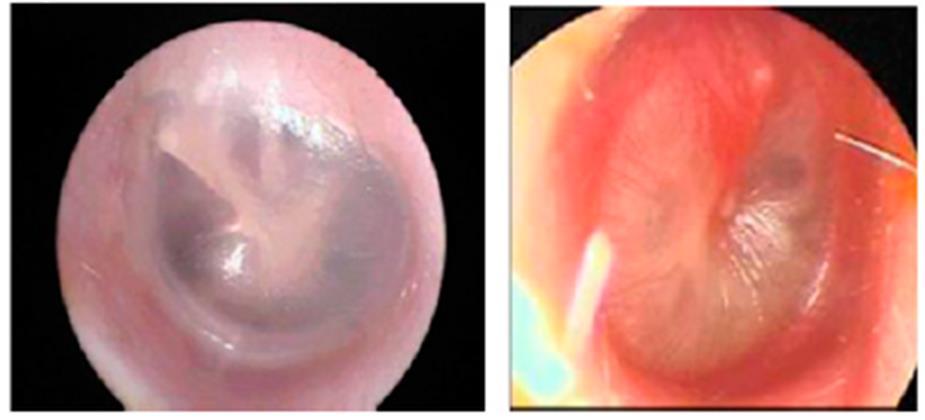 AOM Otoskop Bulguları Şişkinlik Opak görünüm Normal