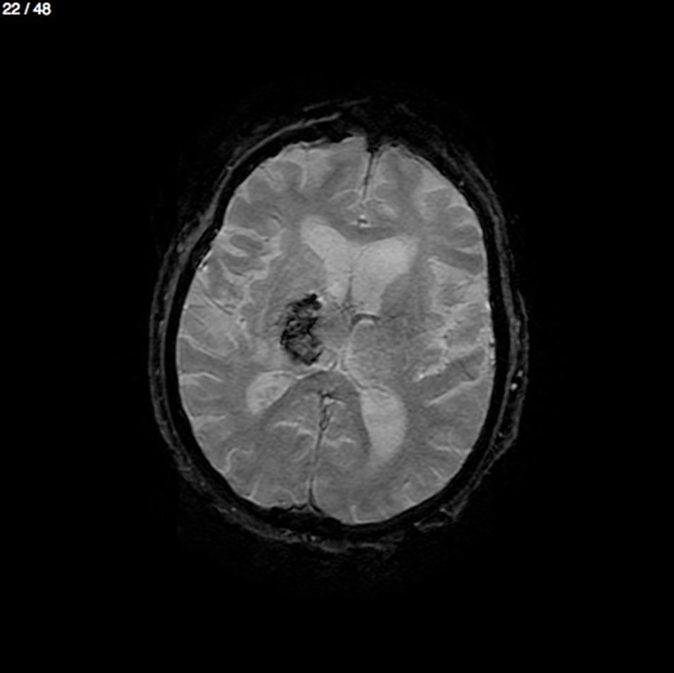 Sagital T1, koronal T2, aksial T1-T2, FLAIR ve diffüzyon ağırlıklı görüntüleme, RADYOLOJİK BULGULAR Serabellar folyumlar belirgindir. 4. ventrikül normaldir.