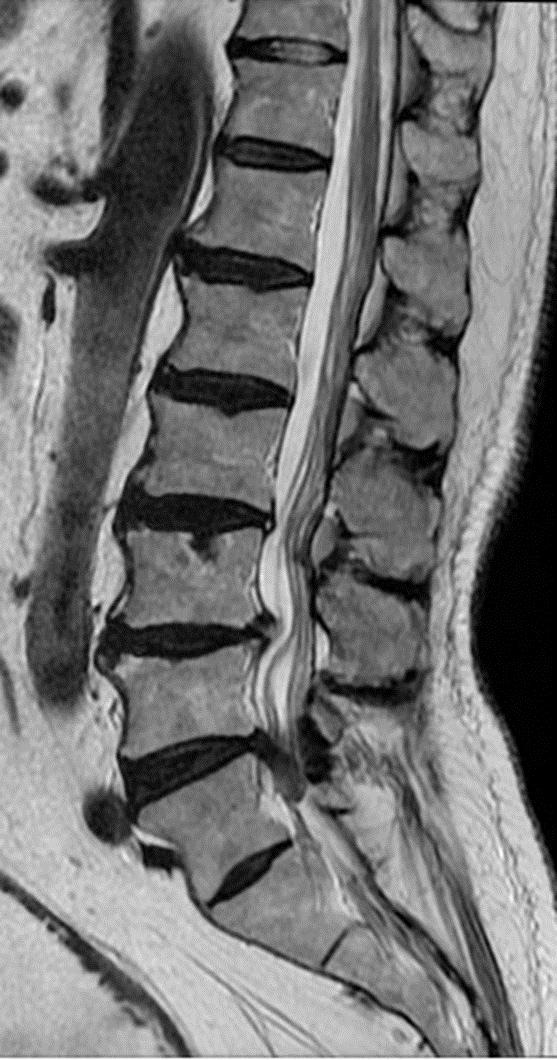 Radyolojik Yorum : Lomber bölge Sagittal MR görüntüsü Lomber lordozda düzleşme. L4 sol laminektomi.