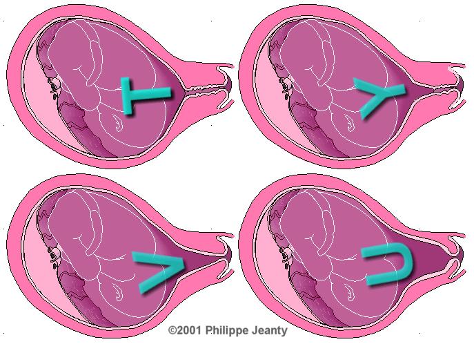 Trust Your Vaginal Ultrasound (8) İç ve dış servikal delikler net görülmeli.