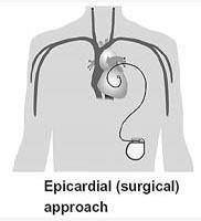 Epikardiyal ICD Yüksek