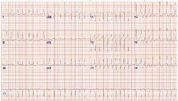 42 yaş, GKS=15, Ajite, oryante 135/85 mmhg, O2sat: