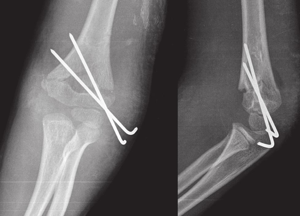 Figure 1a. Figure 1b. Figure 1c. Gartland type 3 fractures are best treated by closed reduction and pin placement (4-6).