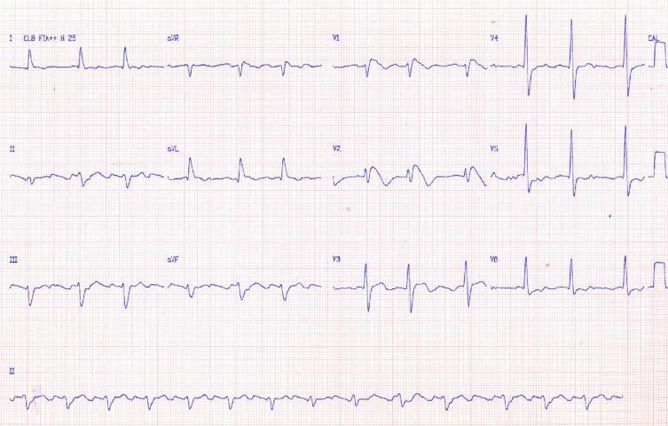 Atrial fibrillation in inherited cardiac channelopathies: From mechanisms to