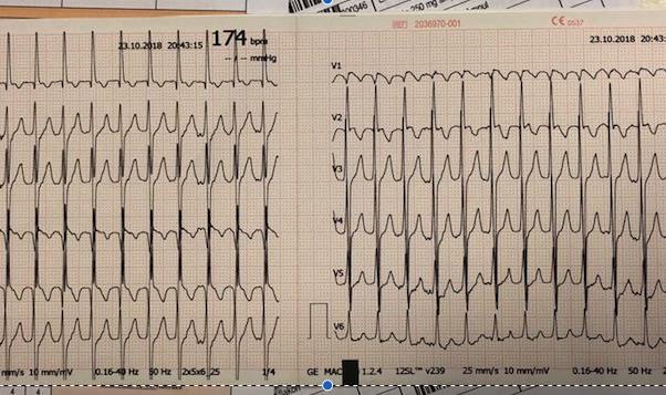 EKG