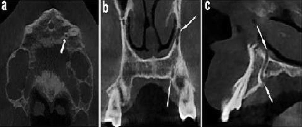 ŞEKİL 1: KIBT görüntülerinde tek taraflı CS, a) aksiyel kesitte 23 nolu diş kökünün palatinalinde CS; b) koronal kesitte CS (oklar); c) sagital kesitte CS nin ağız boşluğu ile burun boşluğu