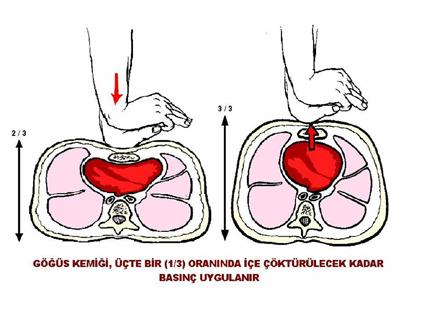 yetişkinlerde olduğu gibi iki el ile kalp basısı uygulanır ), 15- Elin parmakları göğüs kafesiyle temas ettirilmeden, dirsek bükülmeden, göğüs kemiği üzerine vücuda dik olacak şekilde tutulur, 16-