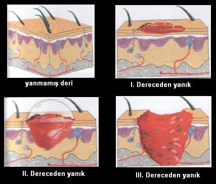 3. derece yanık: Derinin tüm tabakaları etkilenmiştir. Özellikle de kaslar, sinirler ve damarlar üzerinde etkisi görülür. Beyaz ve kara yaradan siyah renge kadar aşamaları vardır.