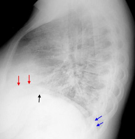 Lateral Grafi - Sağ diyafram (kırmızı oklar) önde yer alır - Sol diyafram (siyah ok) kalbin gölgesi yüzünden seçilemez -