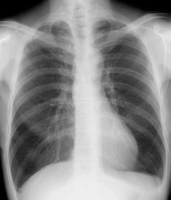 Akciğer Parenkimi ve Hiluslar Hilus Pulmoner arterler Pulmoner venler AC