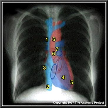 Mediasten ve Kalp gölgesi Kalp boyutu Sağ taraf Inferior vena cava Sağ atrium Ascending aorta