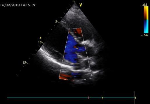 Mitral ve aort yetmezliği(n) 2 (5,1) - Mitral stenoz ( MS)(n) 1 (2,5) - RKH tanısı alan