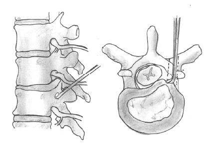 Posterior Yaklaşım