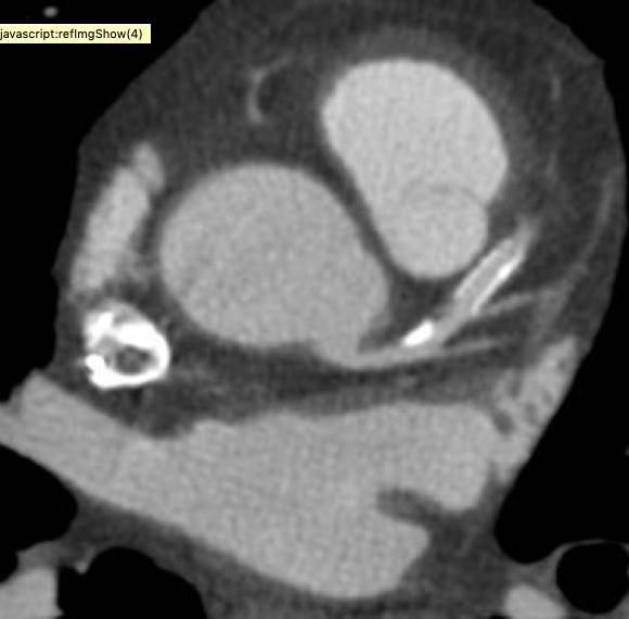 Koroner Arter Stentleri 2010 konsensüs beyanı: Stentli düşük-orta riskli göğüs ağrılı hastalarda stent stenozunu dışlamada KBTA invazif anjiograye makul