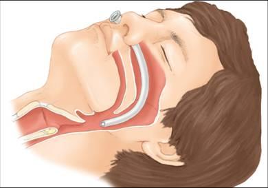 Havayolu Kontrolü-Ventilasyon Nazofaringeal airway - Çene kitlenmiş ise -