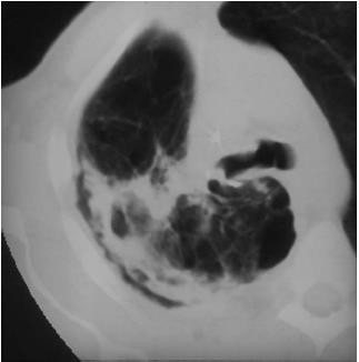 Kronik Kaviter Pulmoner Aspergilloz Bronkoskopi: Lezyon yok Kültür: Aspergillus fumigatus