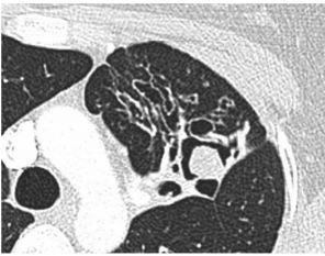 Belirgin olmayan klinik, sistemik ve serolojik bulgular İmmunkompetan Görüntülemede parankimal, pulmoner