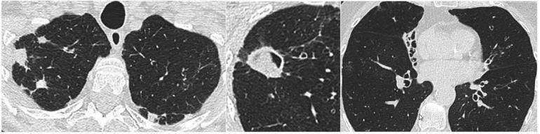 Aspergillus Nodül Ayırıcı tanı: Metastatik akciğer karsinomları