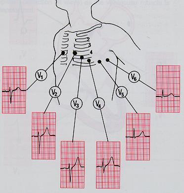 derivasyonları (frontal plane): Lead avr: RA (+) to [LA & LF] (-) (Rightward) Lead avl: LA (+) to [RA & LF] (-) (Leftward) Lead avf: LF (+)