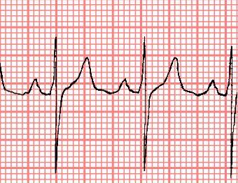 EKG de hız saptanması 300 / büyük kare sayısı yada 1500 / küçük kare sayısı R R 300 / 3 =