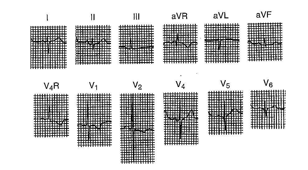 Yenidoğan QRS voltajları düşük Sağ aks deviasyonu Prekordial derivasyonlarda sağ ventrikül hakimiyeti V1 de yüksek R (10 mm üstündeyse RVH) (R/S oranı artmış)