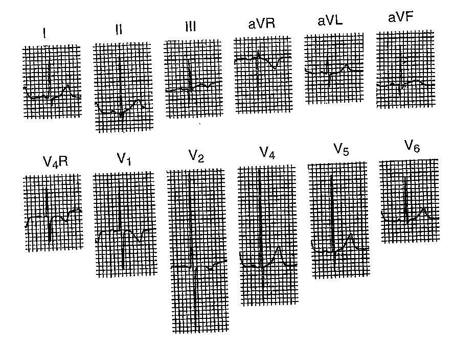 1-6 ay Sağ aks kaybolur ve QRS aksı +90 altındadır (+125 normal kabul edilir) V4r ve V1 de R dominansı devam eder V2 de